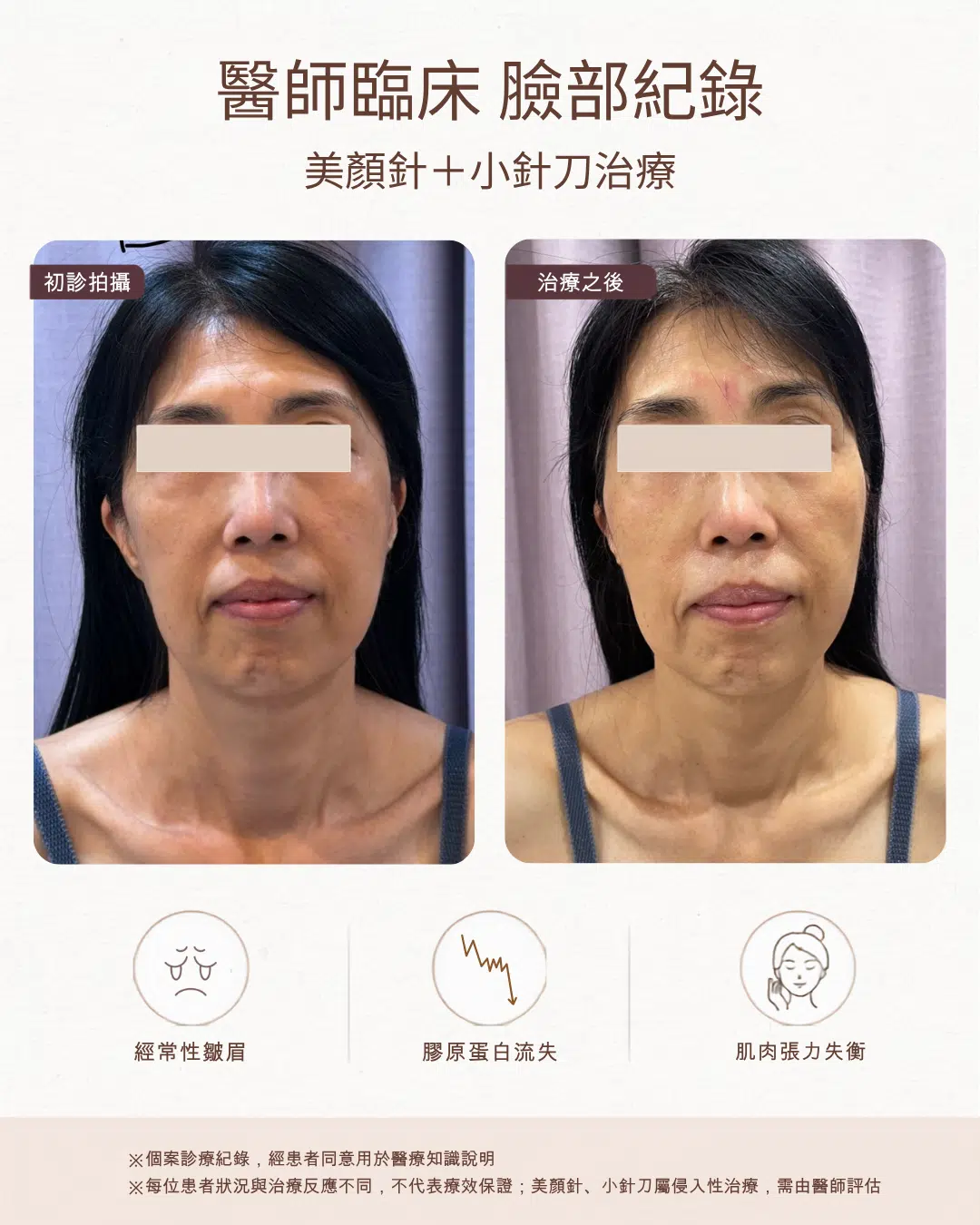 【劉盈盈醫師聊聊天】睡得夠卻總覺得沒精神?臉上的疲態,可能來自你沒發現的皺眉習慣 【劉盈盈醫師聊聊天】睡得夠卻總覺得沒精神?臉上的疲態,可能來自你沒發現的皺眉習慣