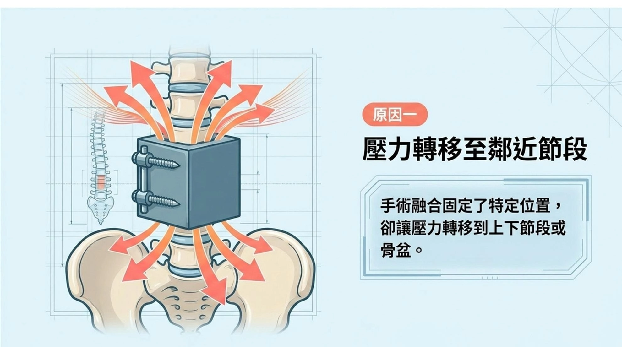 【黃醫師聊聊天】開完刀還是痛？其實你的腰，只是「卡」住了